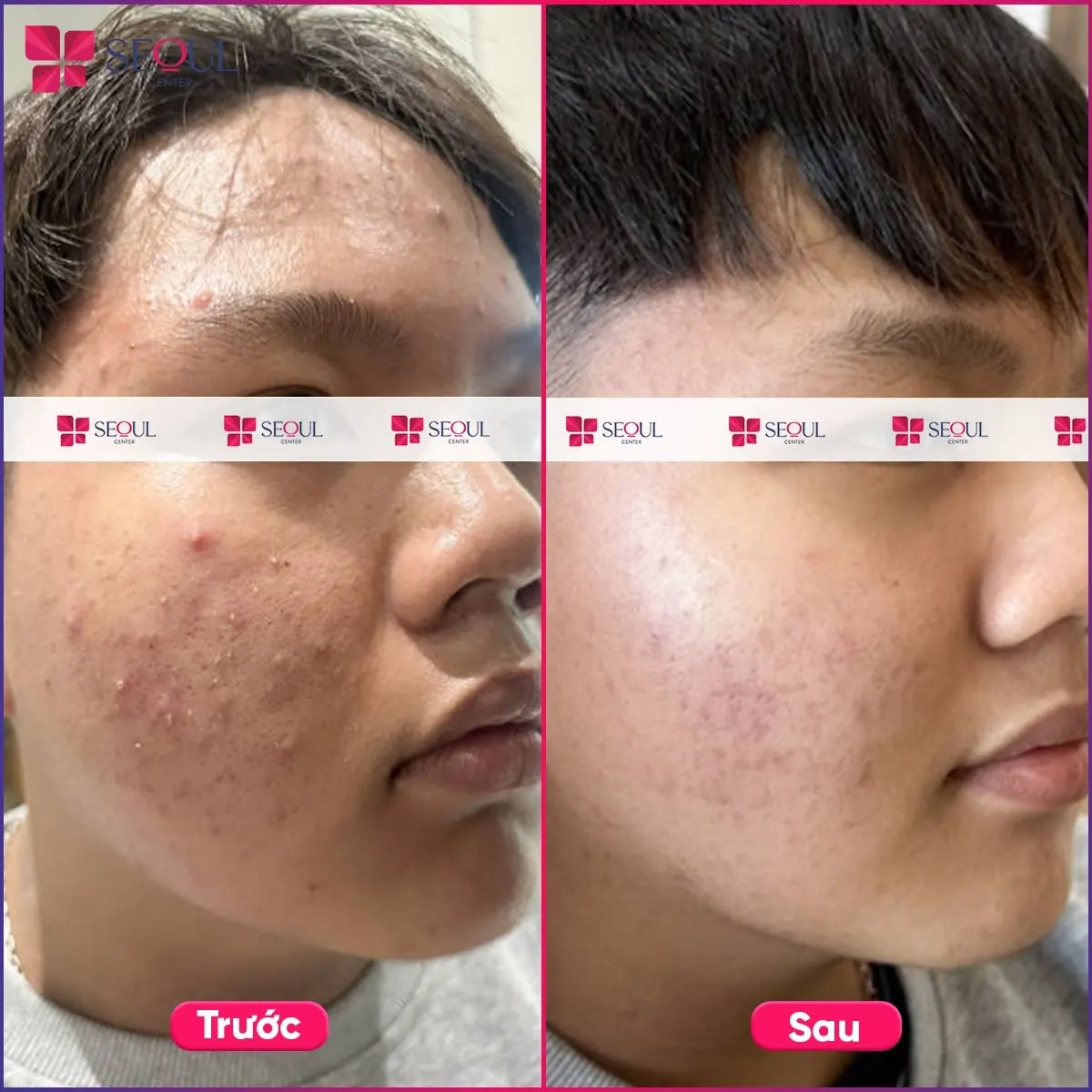 Mụn viêm, mụn đầu đen đã được loại bỏ, da đã hồi phục khá tốt sau điều trị mụn E2X
