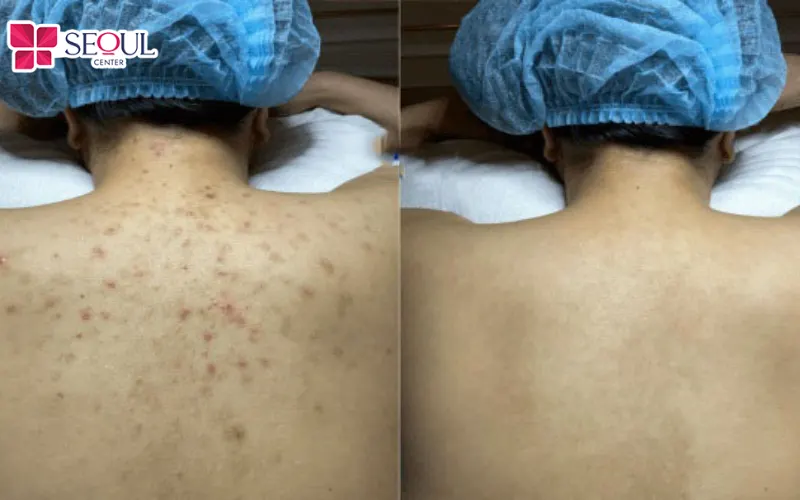 Dịch vụ Điều Trị Mụn LS E2X Lưng sở hữu nhiều ưu điểm vượt trội