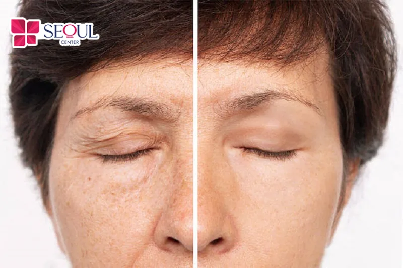 Những người có da chùng, mỡ thừa mí trên, bất cân xứng cung mày nên Nâng Cung Chân Mày để khắc phục