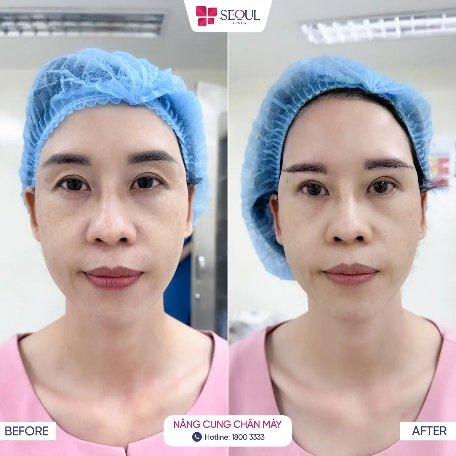 Sau khi Nâng Cung Chân Mày diện mạo chị khách tươi tắn, trẻ trung hơn