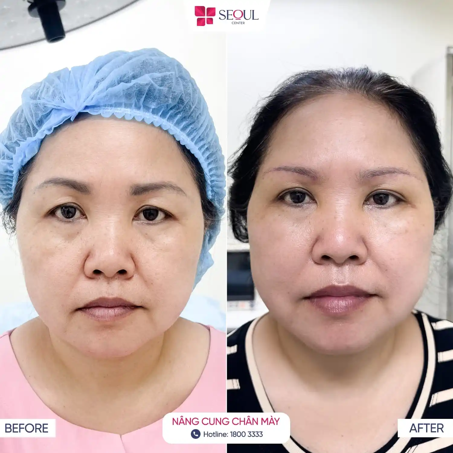 Chị khách đã rũ bỏ u buồn, thăng hạng nhan sắc sau khi thực hiện Nâng Cung Chân Mày