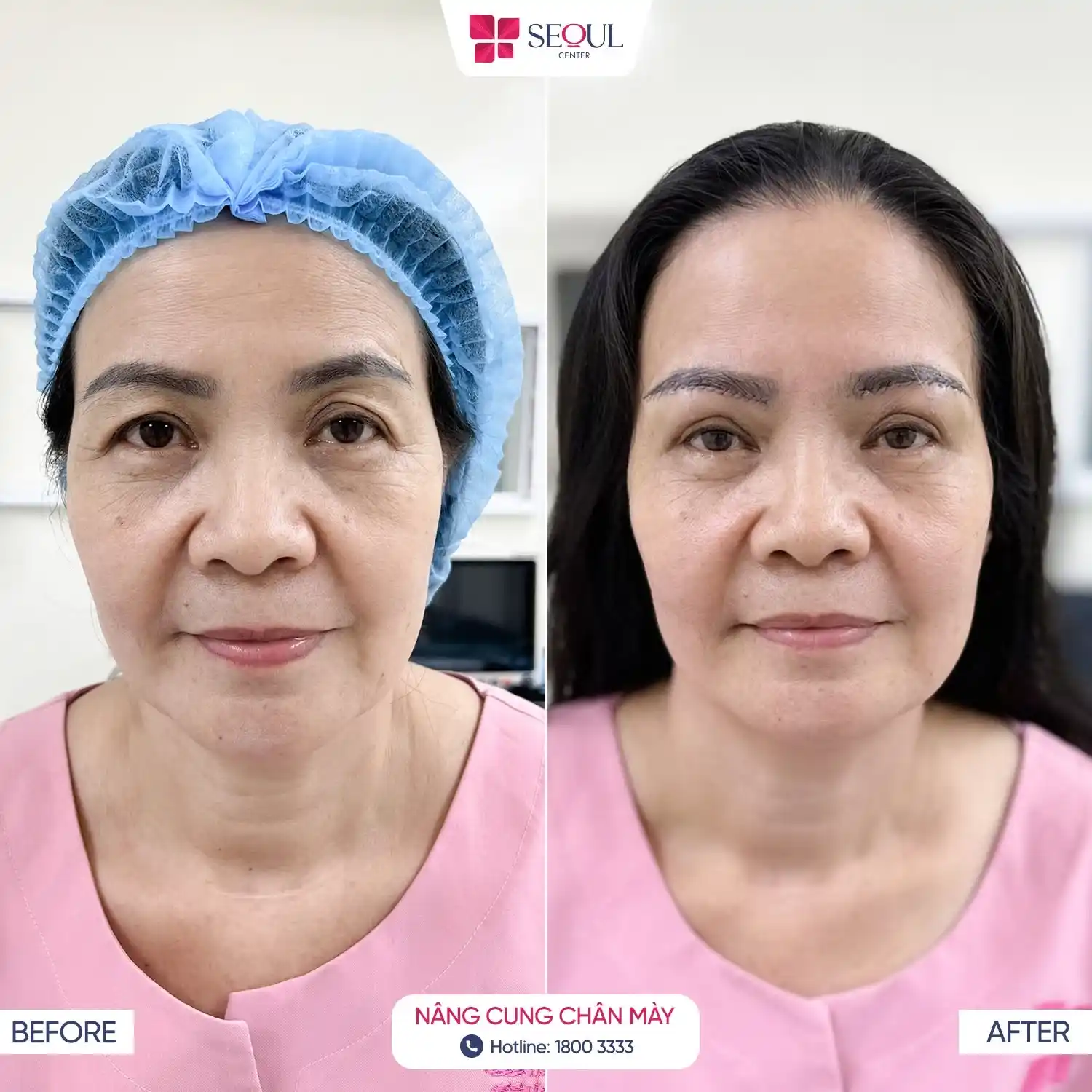Diện mạo chị khách tươi tắn, nhuận sắc, rạng rỡ hơn sau khi Nâng Cung Chân Mày