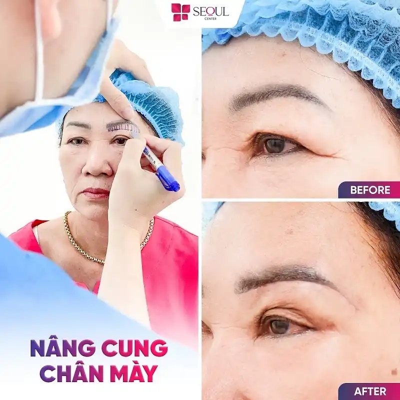 Nâng Cung Chân Mày giúp loại bỏ phần da chùng, mỡ thừa mí trên giúp trẻ hóa vùng mắt cho chị khách