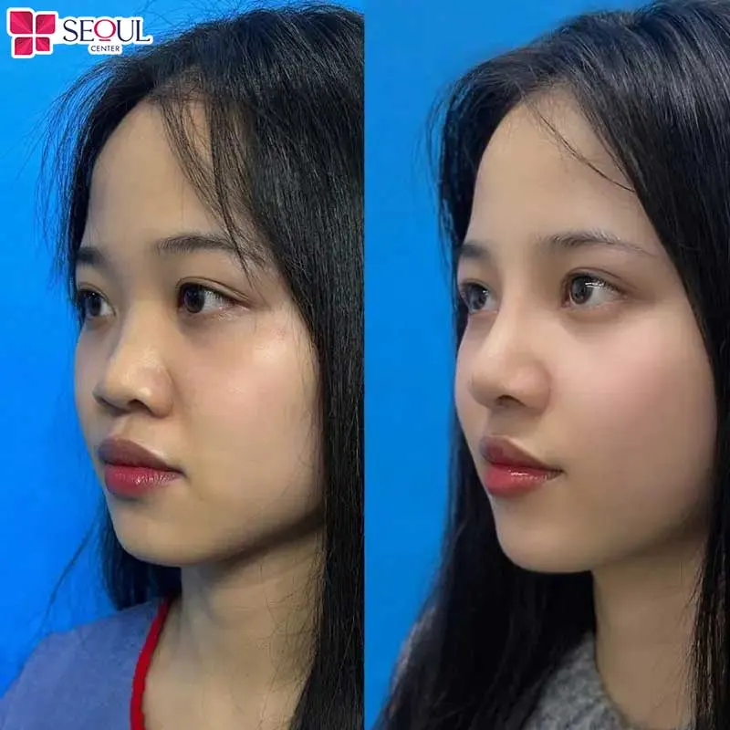 Nâng mũi bán cấu trúc sở hữu nhiều ưu điểm vượt trội được nhiều chị em yêu thích áp dụng
