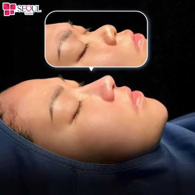 Những ai có dáng mũi tương đối ổn định nhưng cần điều chỉnh nhẹ phần sóng hoặc đầu mũi rất phù hợp nâng mũi bán cấu trúc