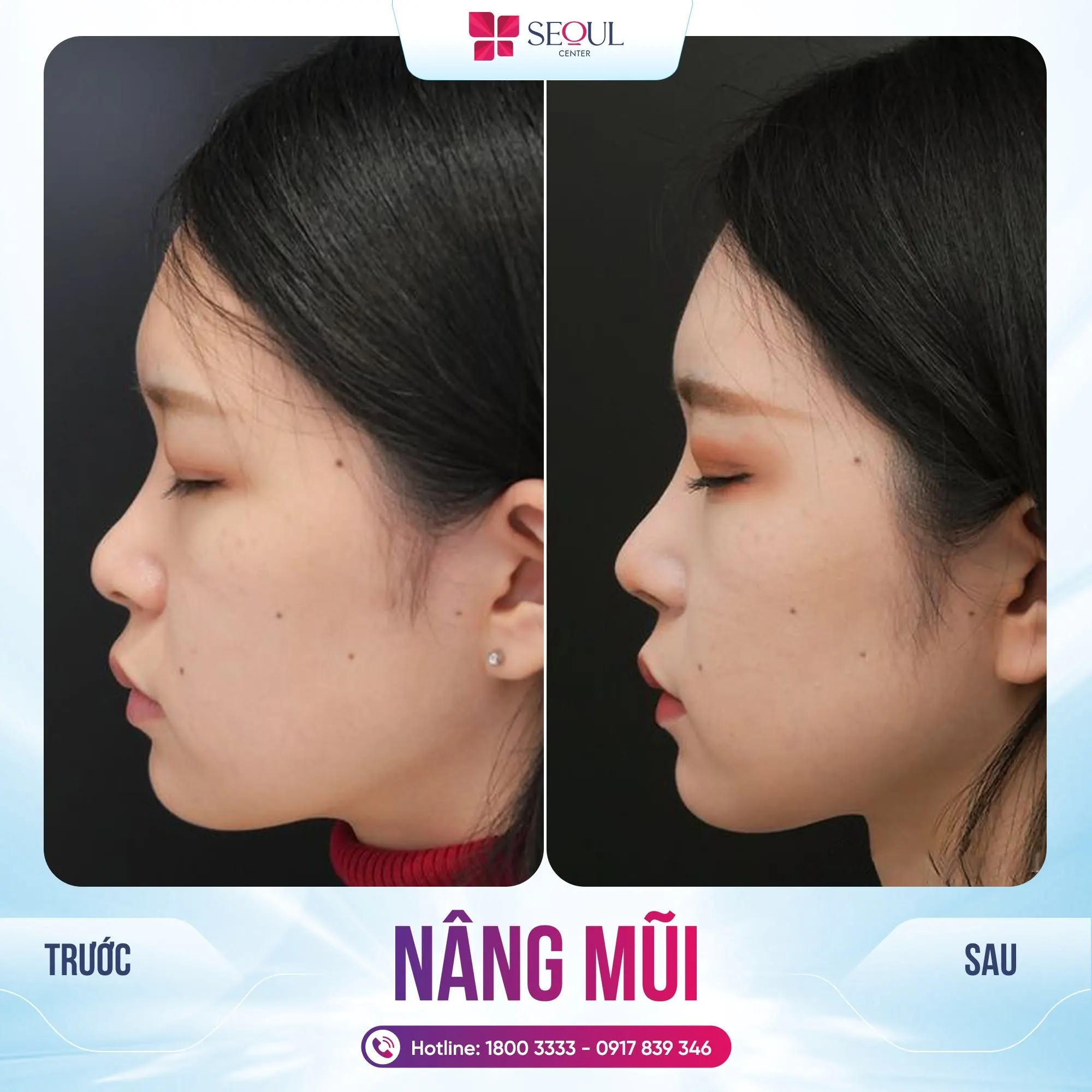 Nâng mũi bán cấu trúc giúp cô gái tạo dáng mũi cao nhẹ nhàng, tự nhiên, phù hợp gương mặt