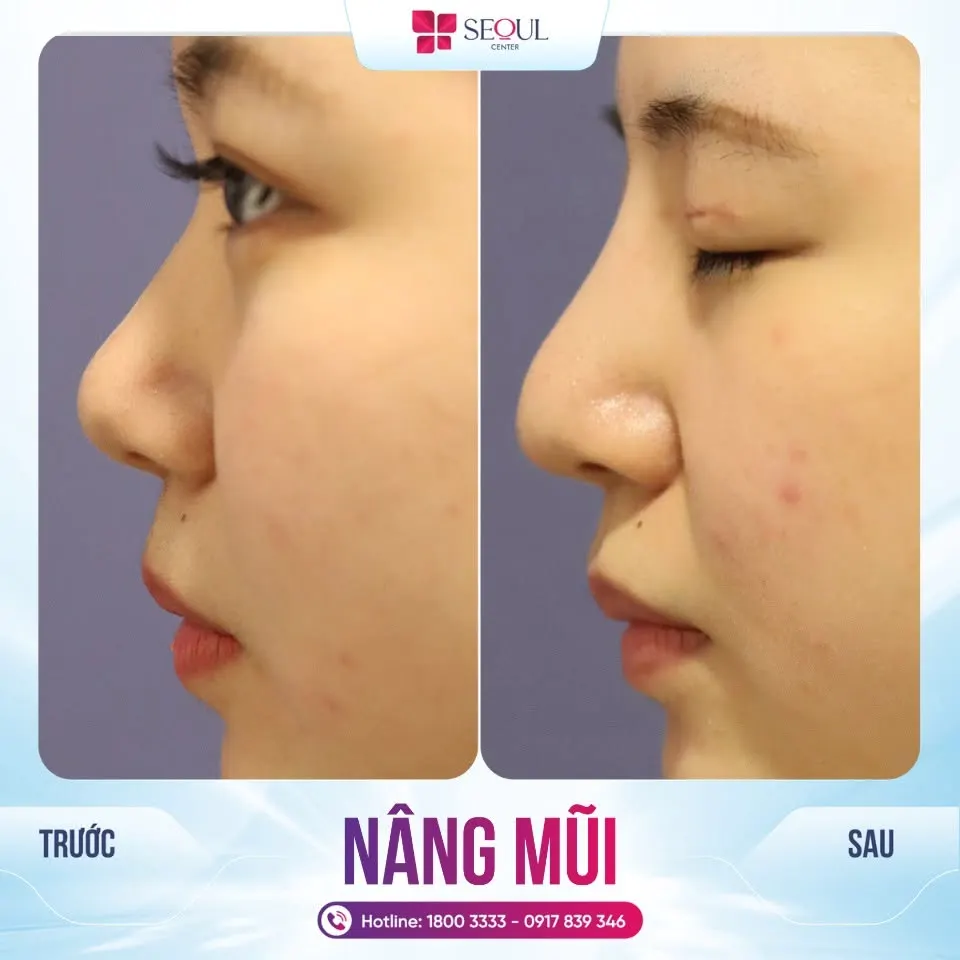 Sau khi nâng mũi cấu trúc, dáng mũi cô gái trở nên cao thanh tú, sang trọng, cân đối hài hòa hơn