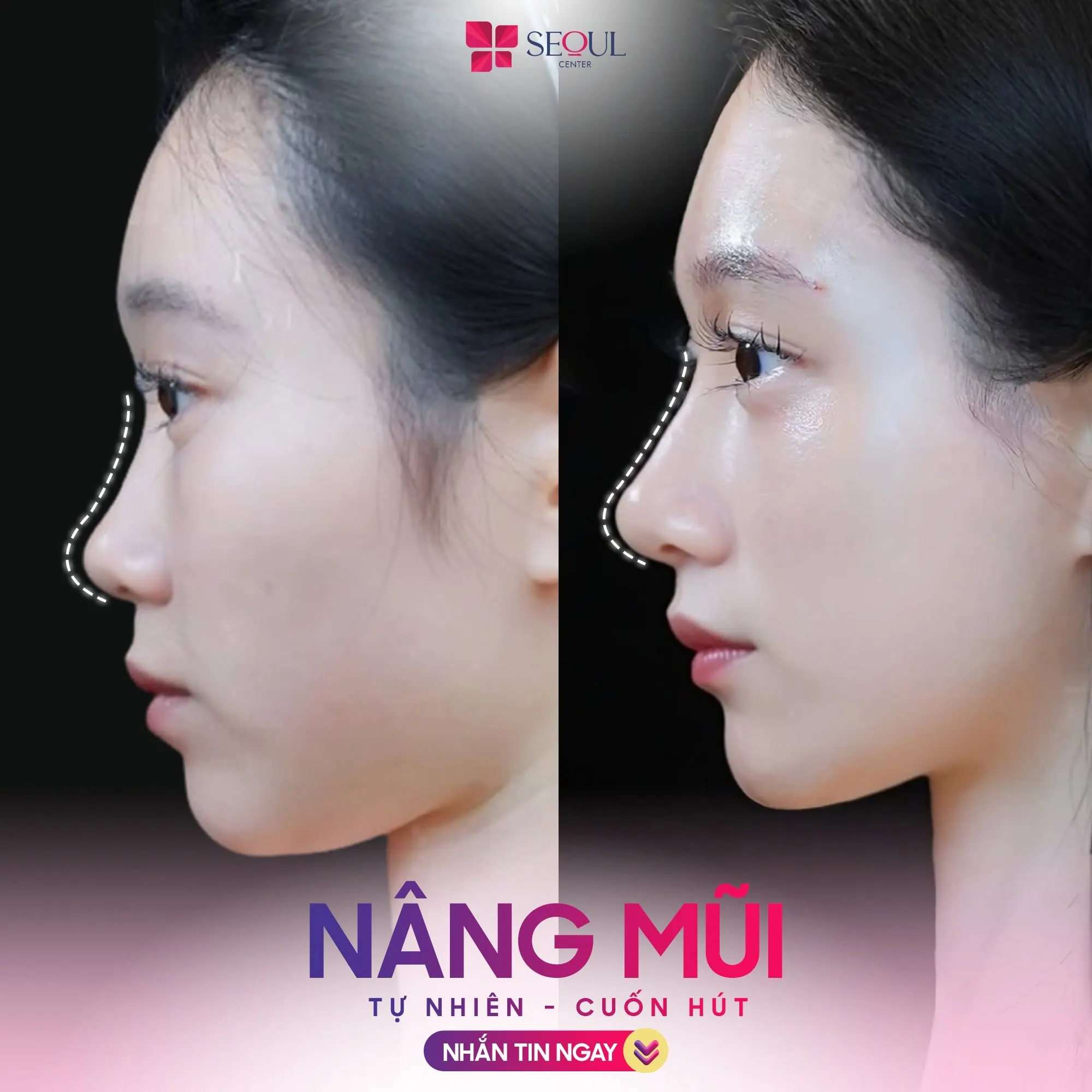 Sóng mũi cô gái được nâng cao tạo góc nghiêng sắc nét, thanh thoát giúp gương mặt cô gái trở nên tươi tắn, xinh xắn hơn