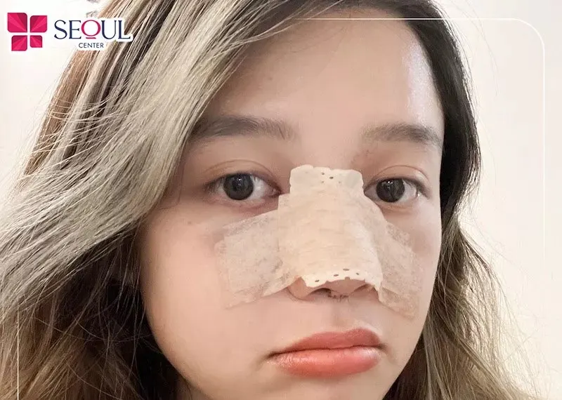 Sau nâng mũi khoảng 3 - 4 ngày sẽ tháo nẹp