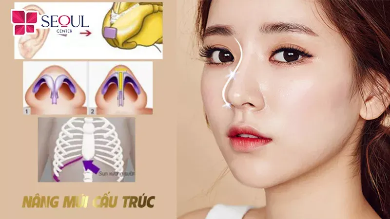 Tuỳ vào phương pháp nâng mũi mà thời gian tháo nẹp có thể nhanh hay chậm