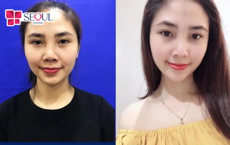Nâng Mũi Sửa Lại giúp khắc phục các tình trạng mũi bị lệch, lộ sóng, co rút, bóng đỏ sau lần nâng mũi trước, tạo dáng mũi mới cân đối hài hòa, đẹp tự nhiên