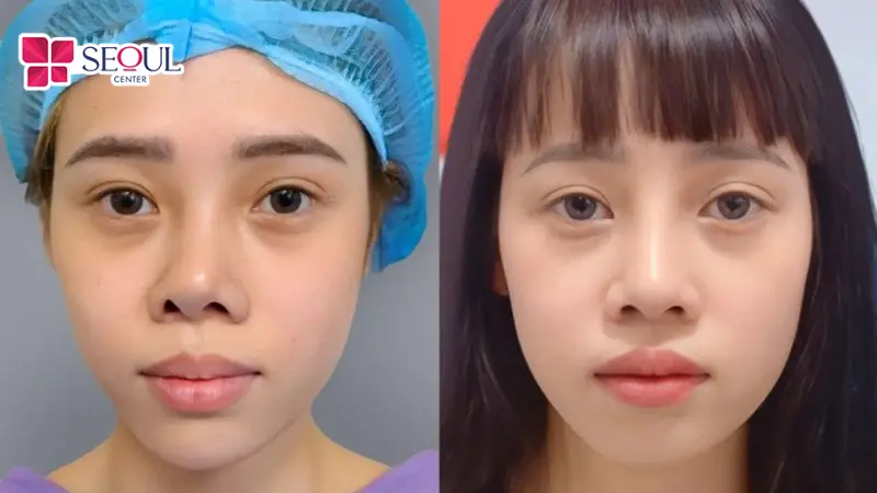 Nâng Mũi Sửa Lại giúp khách hàng khắc phục các lỗi mũi hỏng, tạo dáng mũi cân đối hài hòa bền đẹp cho khách hàng