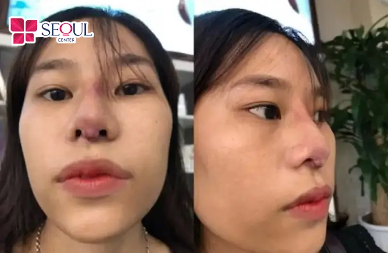 Những ai gặp phải tình trạng đầu mũi bóng đỏ, sống mũi gồ ghề, lệch trụ có thể tham khảo sử dụng dịch vụ Nâng Mũi Sửa Lại tại Seoul Center để khắc phục