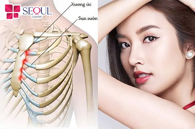 Nâng mũi bằng sụn sườn sử dụng sụn tự thân từ chính cơ thể khách hàng để nâng cao dáng mũi