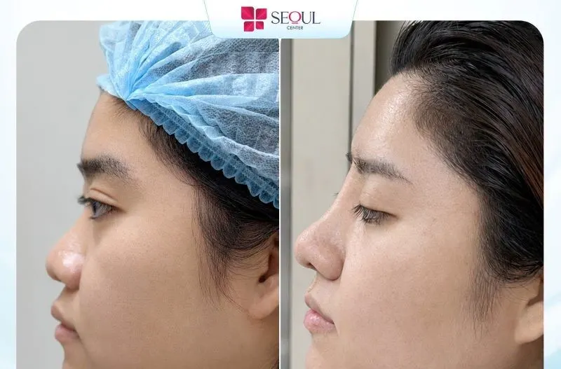 Phẫu thuật nâng mũi sụn sườn thường kéo dài 2–3 tiếng, thời gian hồi phục tùy cơ địa và cách chăm sóc hậu phẫu.