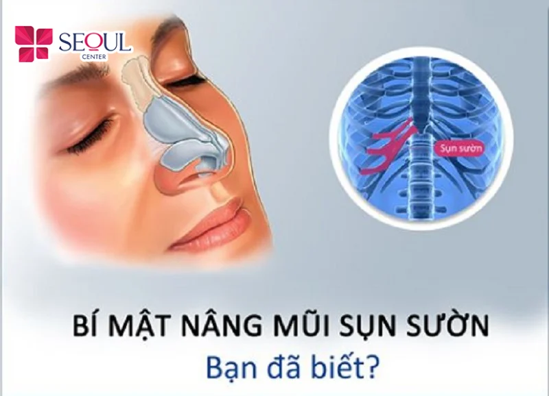 Sụn sườn sau nâng mũi có thể duy trì dáng tương đối ổn định nếu được xử lý và đặt đúng kỹ thuật.