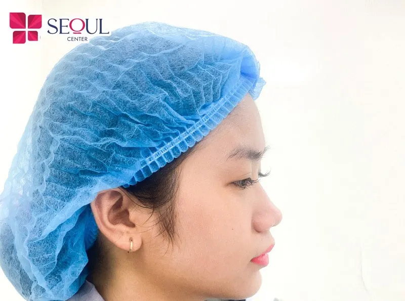 Phương pháp nâng cao sống mũi sử dụng sụn sườn phù hợp với nhiều đối tượng khách hàng