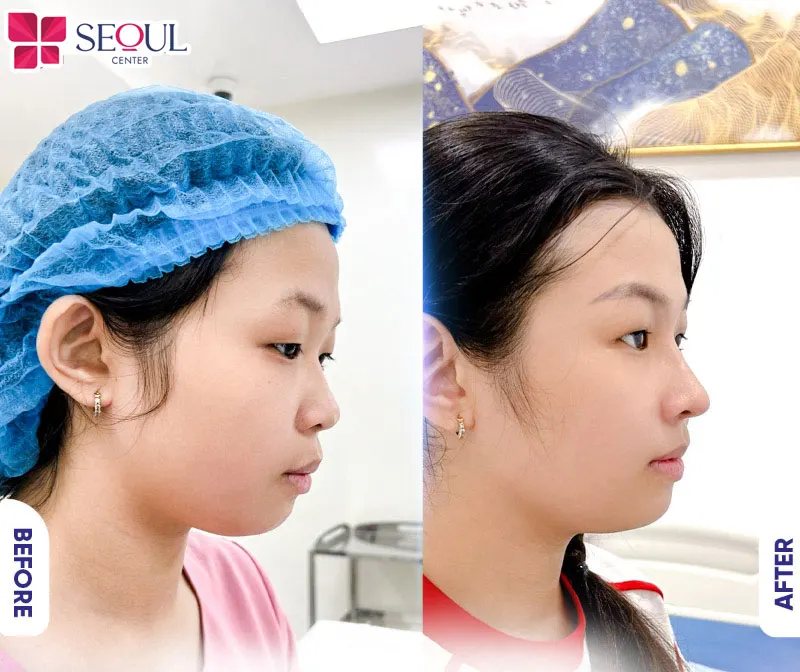 Đầu mũi hếch, sống mũi thấp của khách hàng được khắc phục nhanh chóng