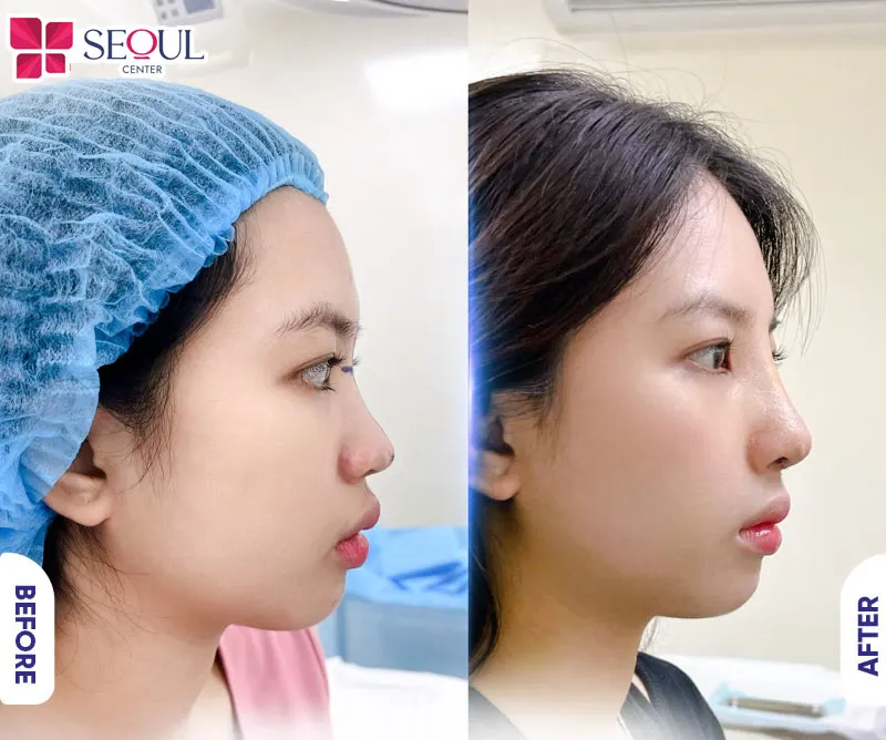 Khách hàng sở hữu khuôn mặt thu hút hơn với dáng mũi cao, cân đối