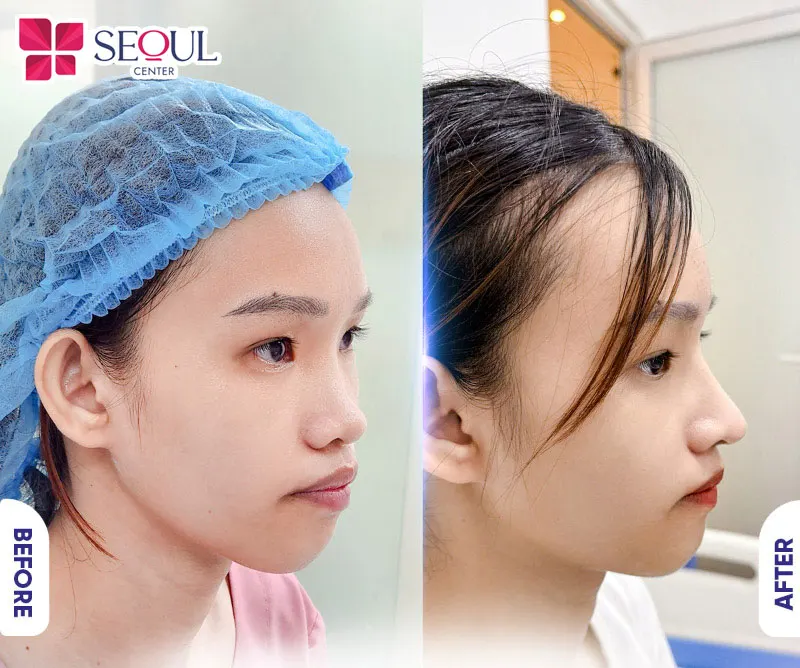 Tổng thể khuôn mặt trở nên thu hút hơn với dáng mũi cao, mềm mại tự nhiên