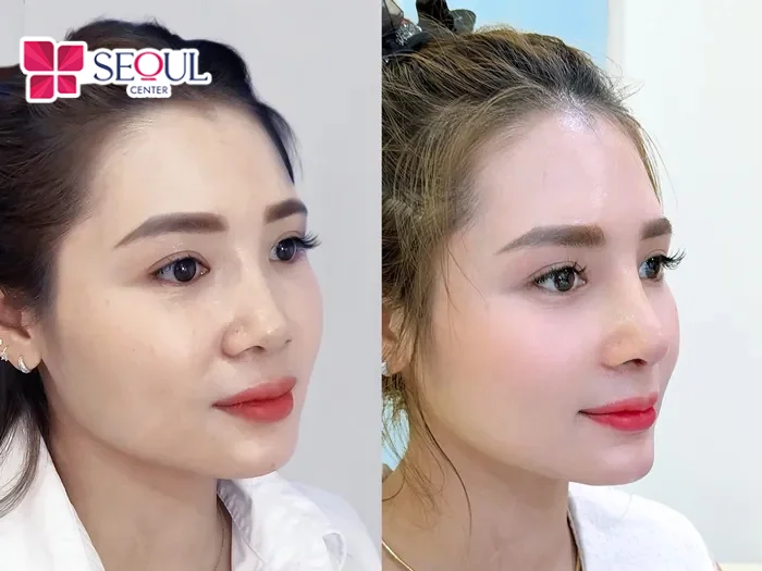 Nâng mũi sụn tự thân giúp duy trì hiệu quả lâu dài nhờ sụn có độ tương thích cực cao, hỗ trợ nâng đỡ cấu trúc mũi.