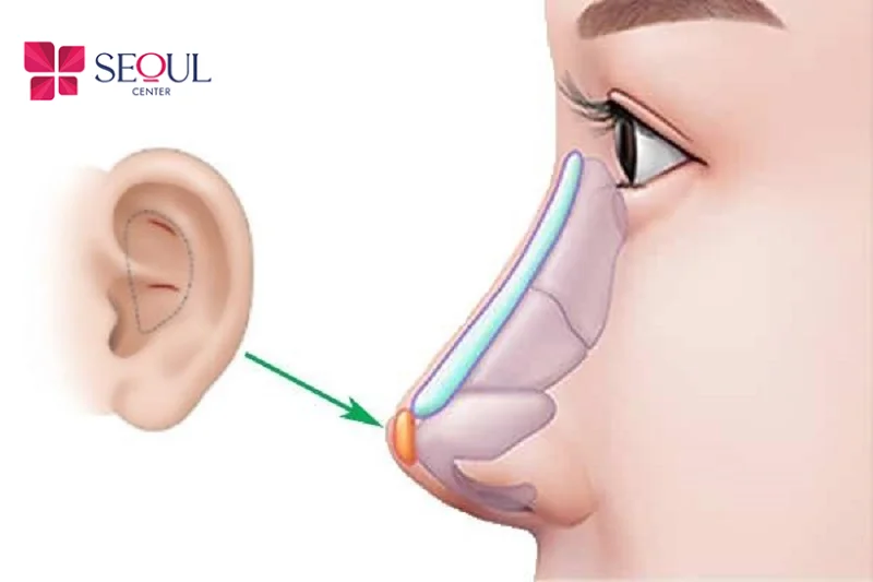 Nâng mũi sụn tự thân giúp giảm các biến chứng đầu mũi