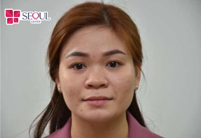 Người có sống mũi thấp, mũi ngắn hếch, đầu mũi to rất phù hợp nâng mũi sụn tự thân