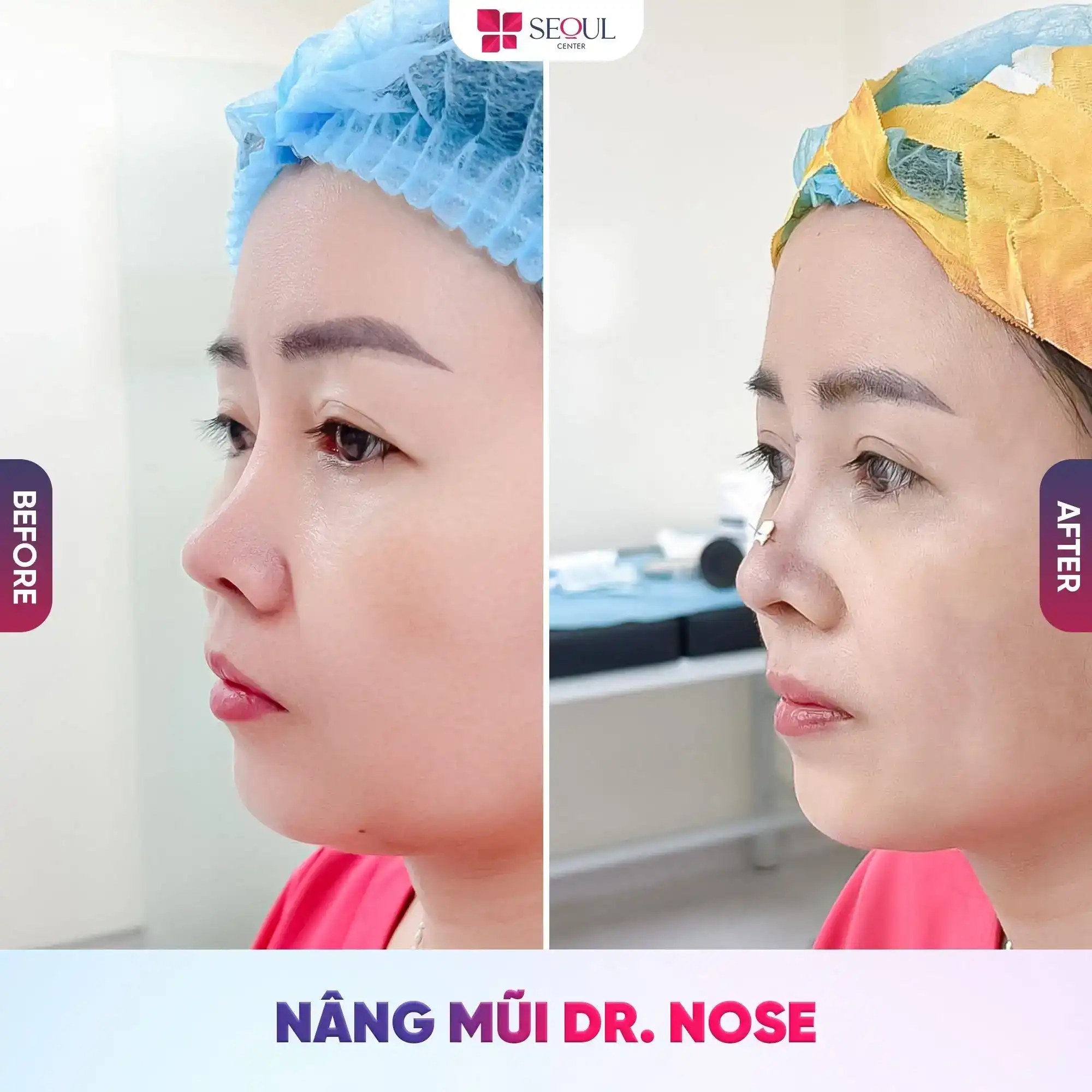 Nâng mũi sụn tự thân giúp nâng cao sống mũi tự nhiên, hướng đến dáng mũi tự nhiên, hài hòa với khuôn mặt.