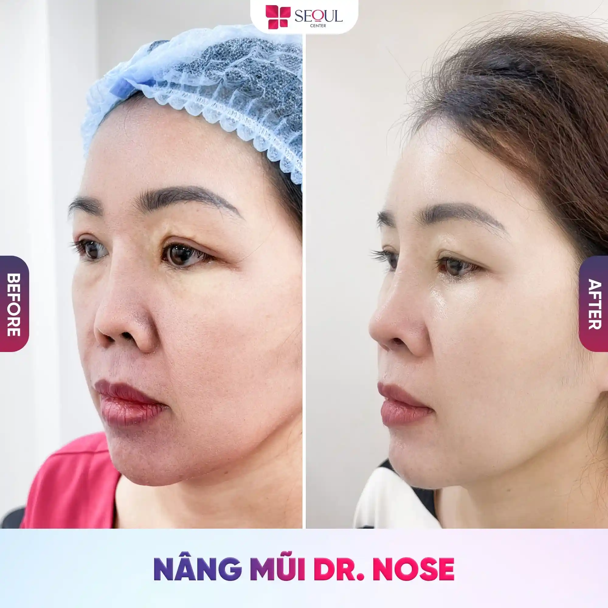 Nâng mũi sụn tự thân giúp tạo hình và cải thiện dáng mũi, thăng hạng diện mạo cho chị khách