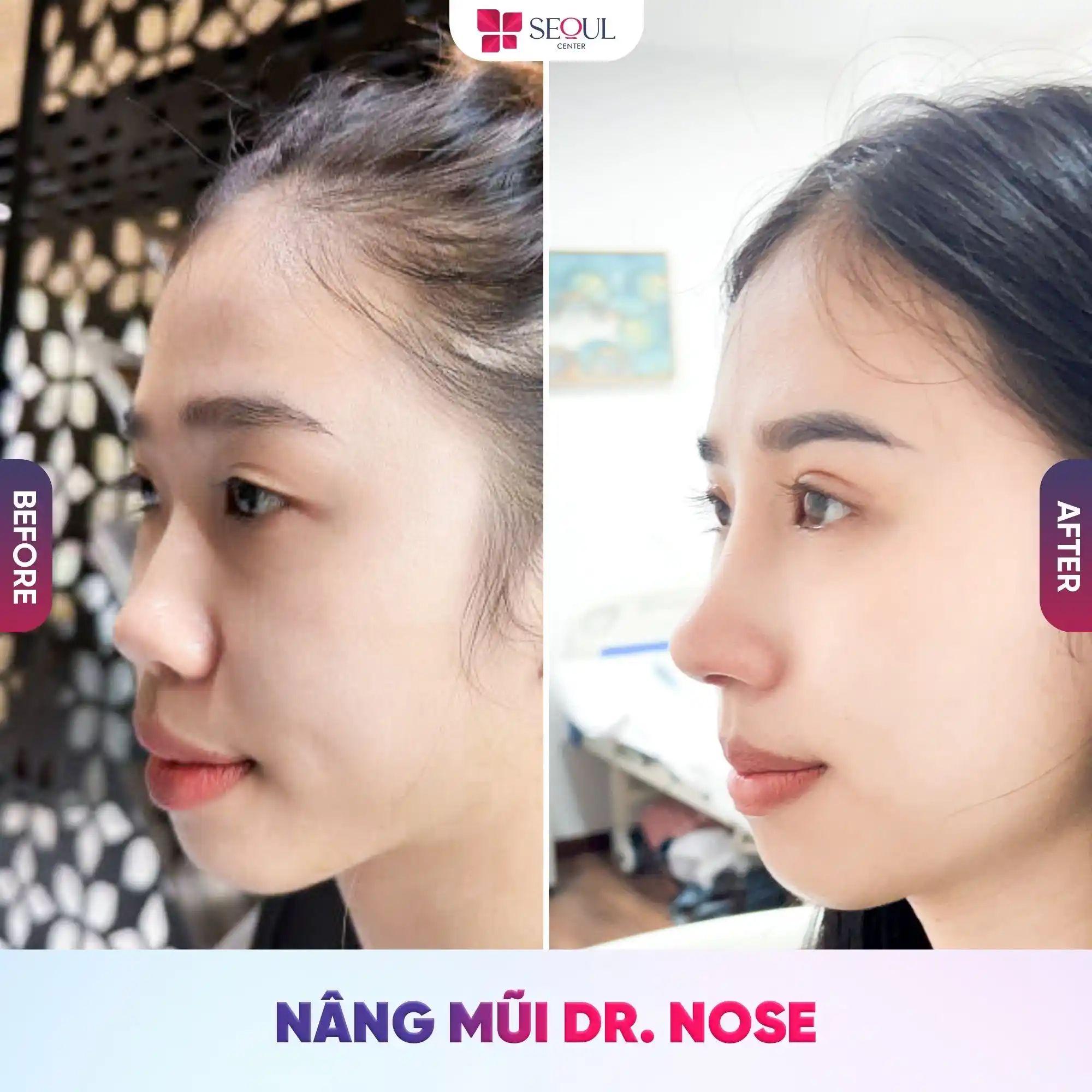 Nâng mũi sụn tự thân giúp cô gái sở hữu dáng mũi tự nhiên, hài hòa gương mặt