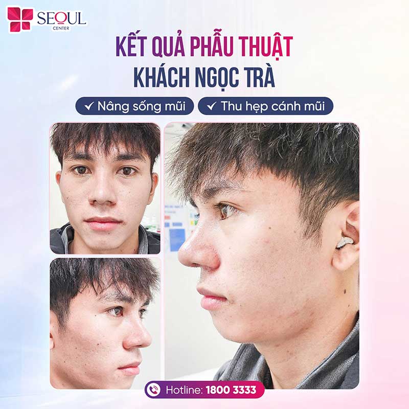 Nâng mũi sụn Surgiform giúp nâng cao sống mũi, tạo dáng mũi hài hòa, tôn lên đường nét gương mặt