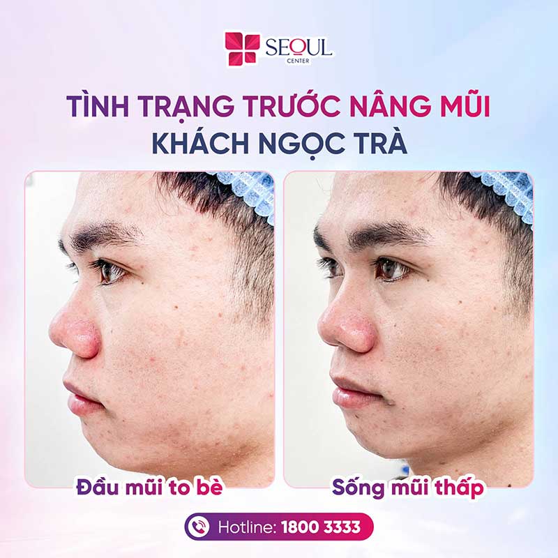 Những người có đầu mũi to bè, sống mũi thấp rất thích hợp nâng mũi sụn Surgiform