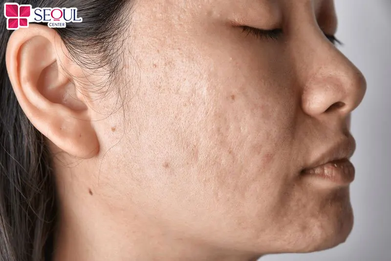 Những ai có da đang bị sẹo rỗ, sẹo lõm, bề mặt da không đều, có mô khuyết thiếu có thể lựa chọn sử dụng dịch vụ Rejuran S – PN Tăng Sinh