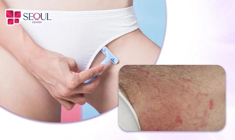 Bôi sản phẩm làm dịu giúp bảo vệ vùng da bikini khỏi vi khuẩn và giảm ngứa rát sau khi cạo
