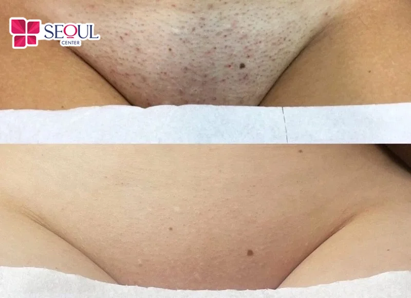 Công nghệ trị thâm bikini Laser Fractional sở hữu nhiều ưu điểm vượt trội, đặc biệt ở khả năng trị thâm hiệu quả, an toàn