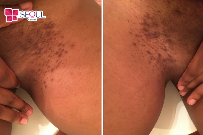 Những ai đang bị thâm xỉn màu vùng kín có thể điều trị thâm bikini bằng Laser Fractional