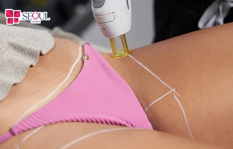 Quá trình trị thâm vùng kín sẽ diễn ra trong không gian khép kín, các bước thực hiện chuẩn an toàn y khoa