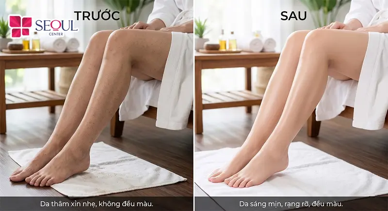Công nghệ trị thâm chân Fractional không chỉ mang lại hiệu quả cao, ít xâm lấn mà còn khá an toàn