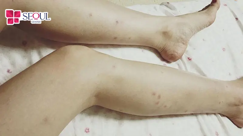 Những ai có da chân bị thâm sạm, xỉn màu, đốm nâu có thể điều trị bằng dịch vụ trị thâm chân Laser Fractional