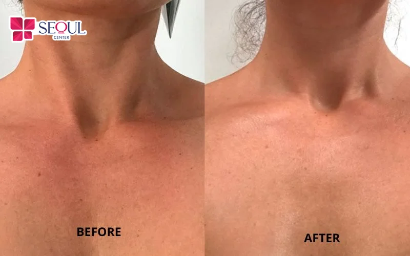 Vùng cổ tối màu do thường xuyên mặc áo hở cổ đã được cải thiện rõ rệt giúp vùng cổ sáng màu hơn