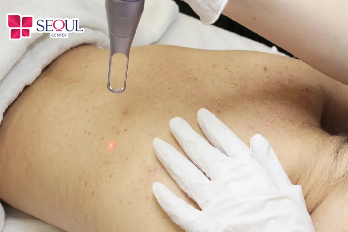 Công nghệ trị thâm Laser Fractional phát ra năng lượng laser tác động theo các điểm vi phân, hỗ trợ cải thiện sắc tố ở vùng da điều trị