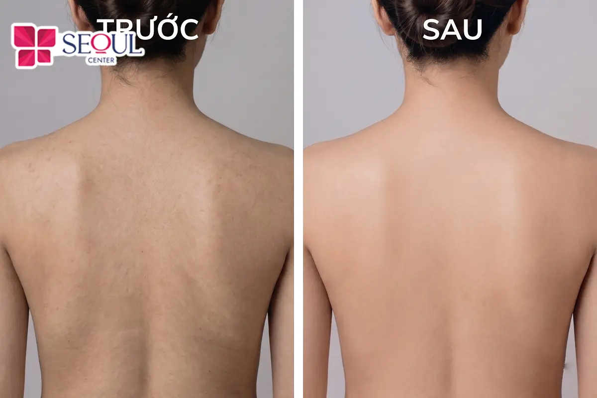 Công nghệ trị thâm lưng Laser Fractional có nhiều ưu điểm được nhiều khách hàng tin tưởng, áp dụng