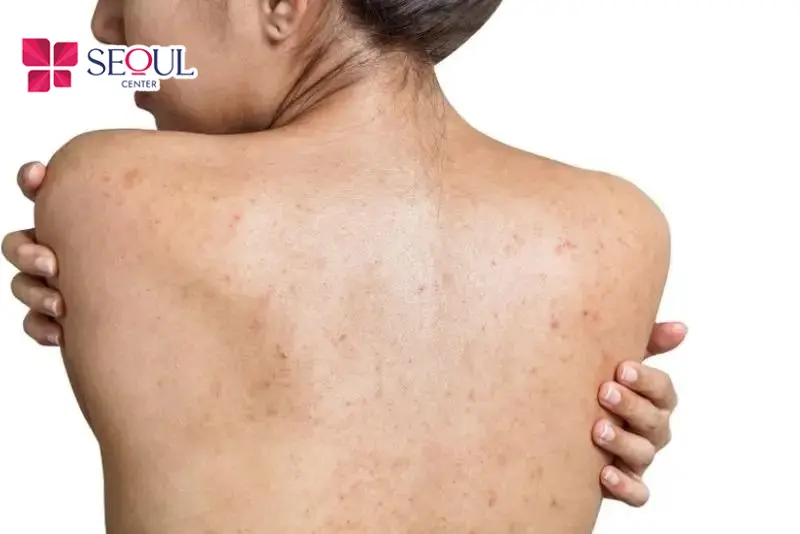 Những cô gái đang tự ti về tấm lưng của mình vì quá nhiều thâm sạm sau mụn, kém sắc, xỉn màu thì đừng quên tham khảo điều trị bằng dịch vụ trị thâm lưng Laser Fractional