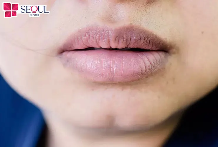Những ai từ 18 tuổi có tình trạng môi thâm xỉn màu, không đều màu