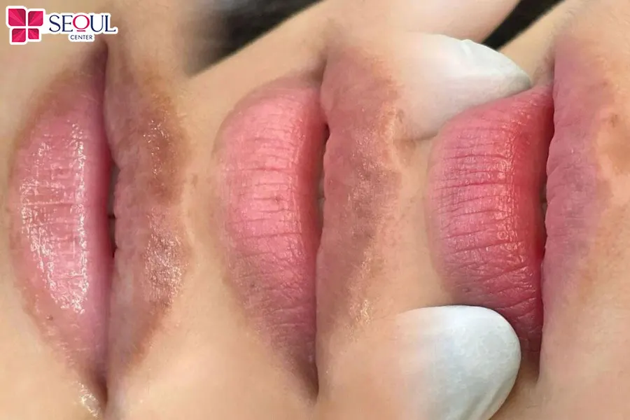 Công nghệ trị thâm FRA sở hữu nhiều ưu điểm vượt trội giúp khắc phục tình trạng thâm hiệu quả, an toàn