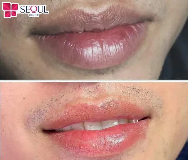 Hình ảnh môi khách hàng trở về màu sắc tự nhiên sau khi trị thâm môi FRA