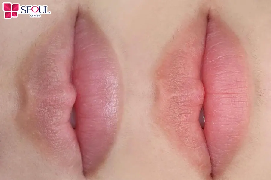 Tình trạng môi thâm, xỉn màu đã được khắc phục sau liệu trình Thâm Môi FRA