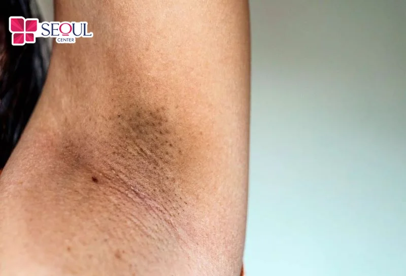 Những ai có vùng nách thâm sạm, kém mịn màng, nổi sần như da gà rất phù hợp áp dụng liệu trình trị thâm này