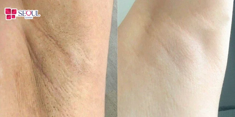 Điều trị thâm nách bằng công nghệ Laser Fractional mang lại hiệu quả vượt trội,với thông số được lựa chọn phù hợp, giúp da vùng nách sáng hơn, đều màu, da mịn hơn