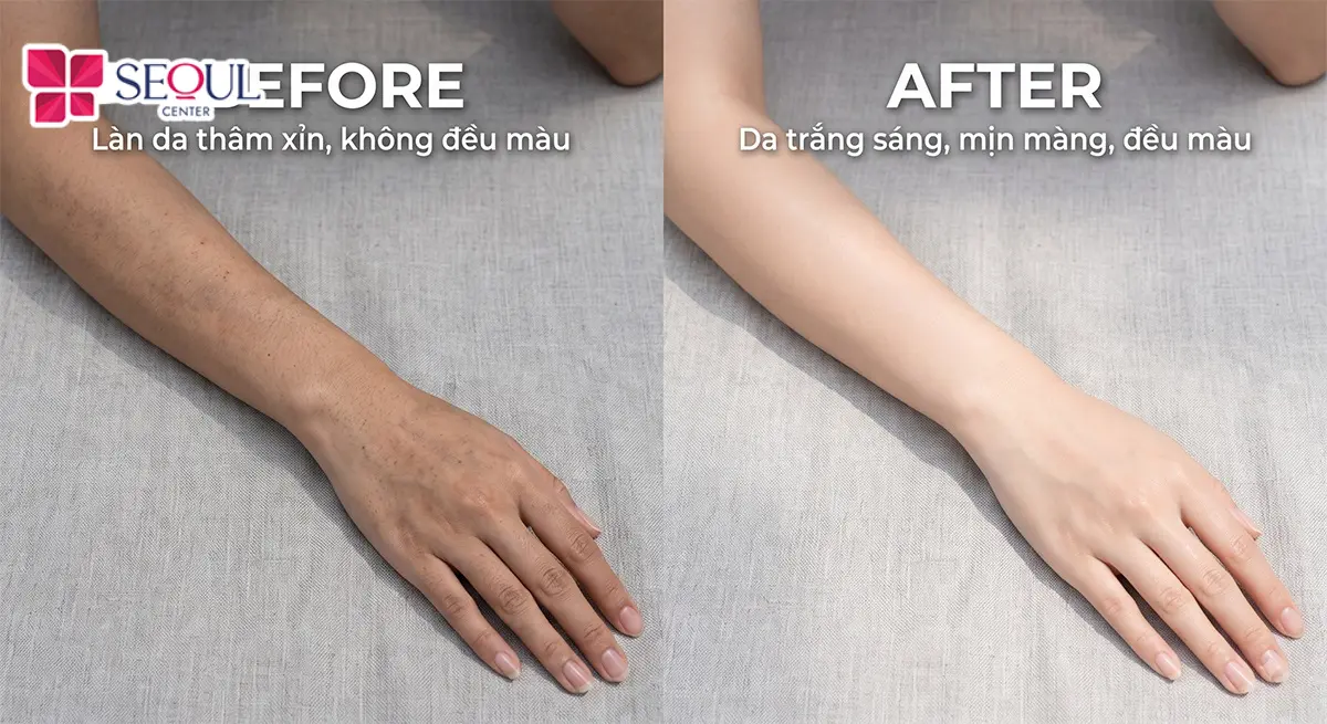 Công nghệ Laser Fractional trị thâm tay sở hữu nhiều ưu điểm vượt trội